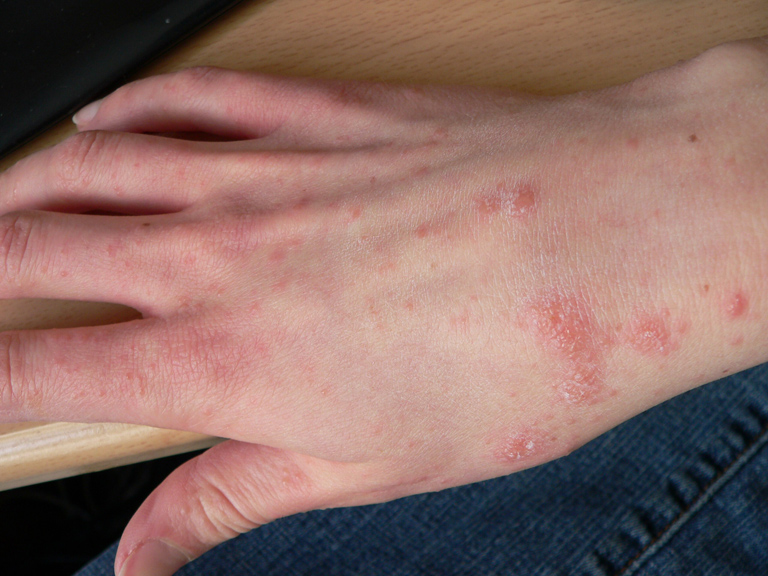 Once Rare, Scabies Is Now a Growing Problem in the Netherlands post image